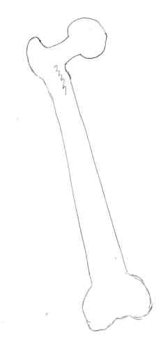 femur-fracture